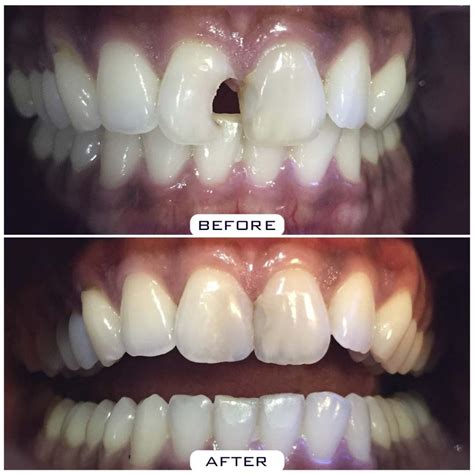 Dental Filling Front Teeth