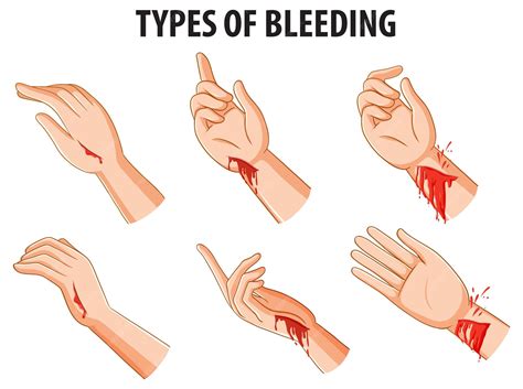 Premium Vector | Comparing different types of bleeding on human arms
