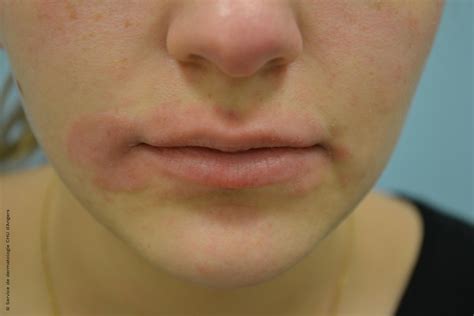Eczema Around Mouth Toddler Treatment at Melvin Jones blog