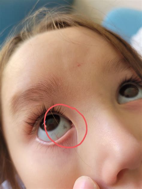 What Are Black Spots Floating In Eyes at Eliza Erik blog
