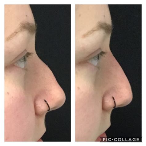 Liquid Nose Job in Avon | Radiant Divine Medical Spa