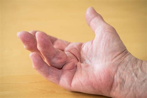 Causes and Treatment for Muscle Contracture