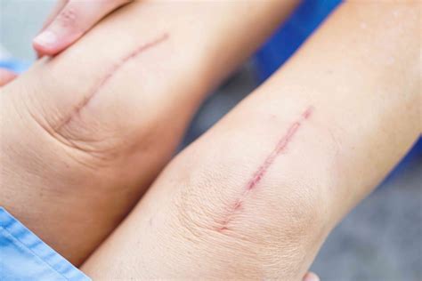 Scarring Wound Surgery at Rita Skelley blog