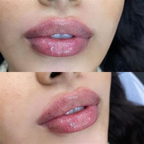 Pin by Nina on Lips | Lips inspiration, Lip fillers, Botox lips