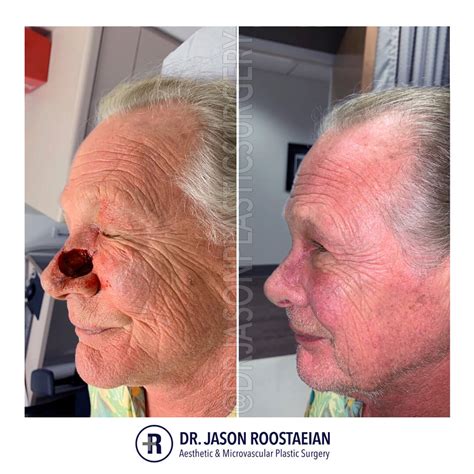 Mohs Procedure Before And After Skin Cancer Surgery Kirwan Plastic