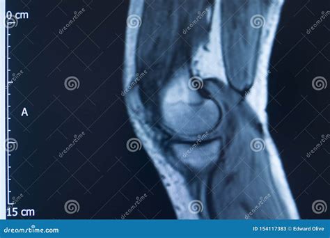 Knee injury mri mcl tear stock image. Image of orthopedic - 154117383