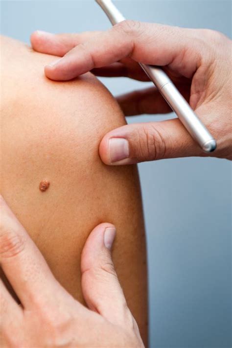 Skin Checks - Glick Skin Institute