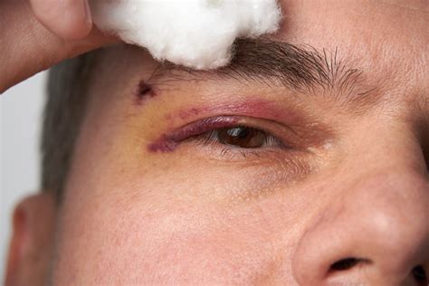 Popped Blood Vessel in Eye - Causes & What to Do