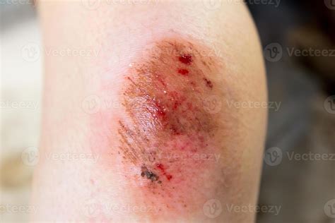 Knee Wound Dehiscence at Seth Darcy-irvine blog