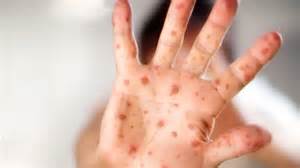 Measles case reported in North Carolina for first time in 2025: What to ...