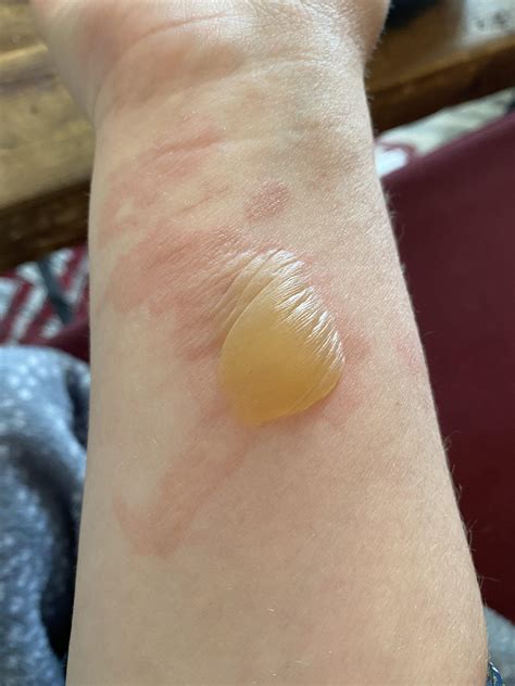 Burn blister...the most forbidden pop I have ever had... 😖 : r/popping