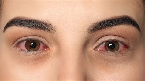 Can Conjunctivitis Cause Blurred Vision? – NutritionFact.in