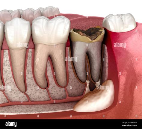 Periostitis tooth - Lump on Gum Above Tooth. Medically accurate dental ...