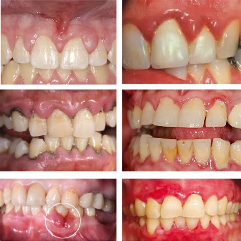 Swollen Gums Should You Worry About Swollen Gums?: Dr. Raminder Singh: