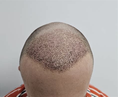 How Long Does Swelling Last After Having a Hair Transplant? - Hair ...