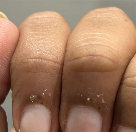 How To Treat Dry Skin Around Fingernails at Sharon Stein blog