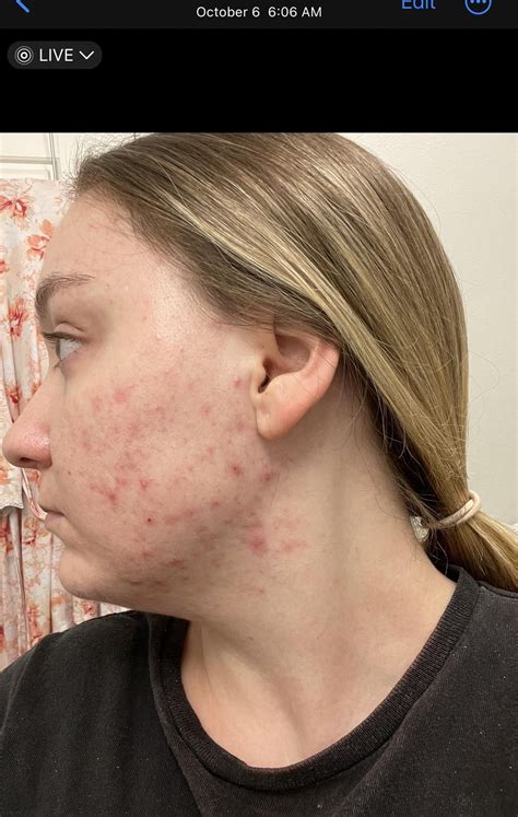 Almost 3 months on Tazorac (Tazarotene) 🙏 with hormonal cystic acne : r/tretinoin