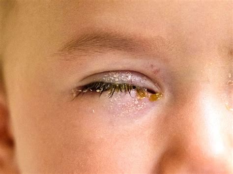 Types of Eye Discharge