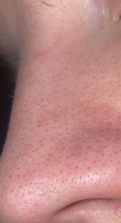 Deep blackhead removal tip? : r/Skincare_Addiction