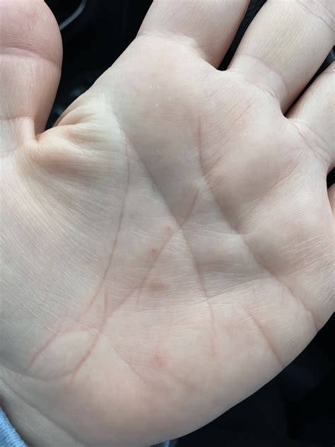 Bumps On Palms Of Hands