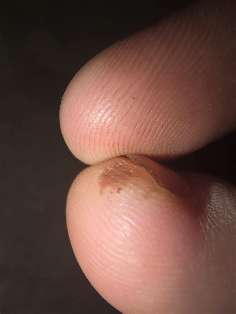 Weird brown splotch on toe : r/DermatologyQuestions