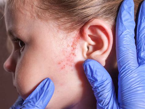 Sarpullidos en los niños : Inmunomédica