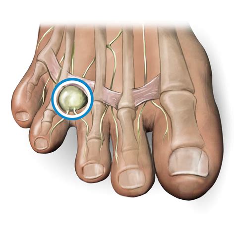 Morton's Neuroma Treatment Exercises - Quotes Trendy