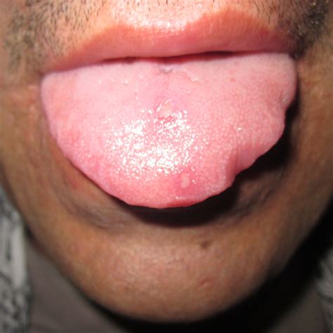 Aphthous Ulcers – DermAlive