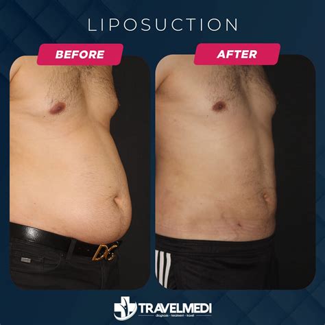 How Much Are Post Lipo Massages at Tyson Walsh blog