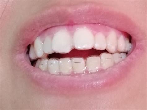 Tiny gap between tooth and aligner : r/Invisalign