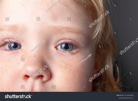 Watery Eyes Babies: Over 90 Royalty-Free Licensable Stock Photos ...