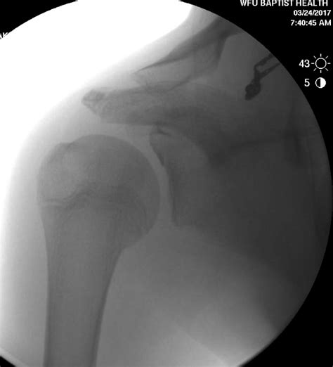 Shoulder and Elbow Surgery: Posterior chondrolabral cleft and recurrent ...