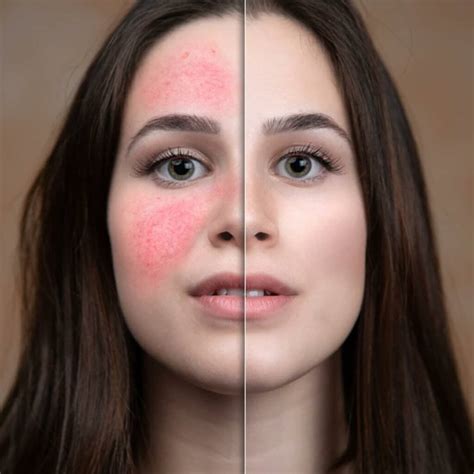 Cost Of Laser For Rosacea at Randall Maupin blog