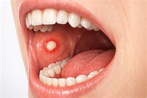 Canker Sore Inside Cheek: Causes, Symptoms & Fast Relief