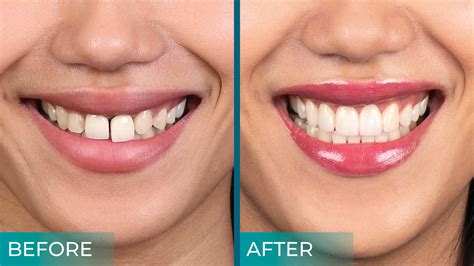 Zirconia Porcelain Crowns Before And After at Jayden Nobbs blog