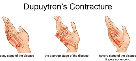 Dupuytren's Contracture | FORM Hand, Wrist & Elbow Institute