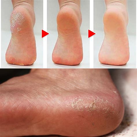 How to Get Rid of Calluses on Feet Naturally – Best Recipes