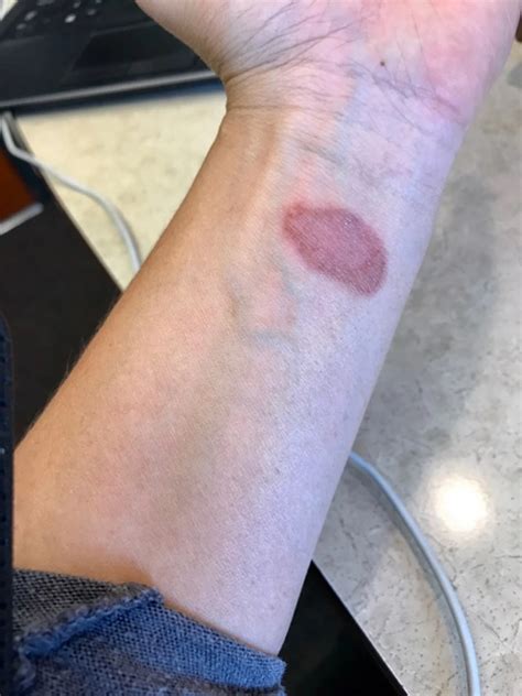 Beauty Pains, Burning Yourself With a Curling Iron Stories