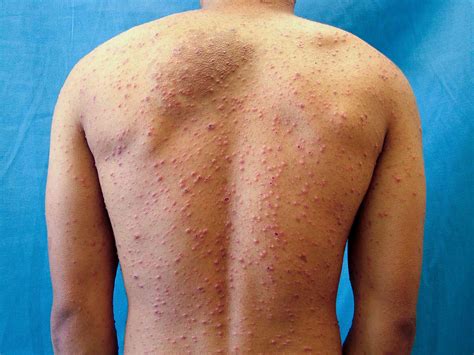 Top Viral Rashes in Babies: Symptoms, Causes, and When to Seek Help