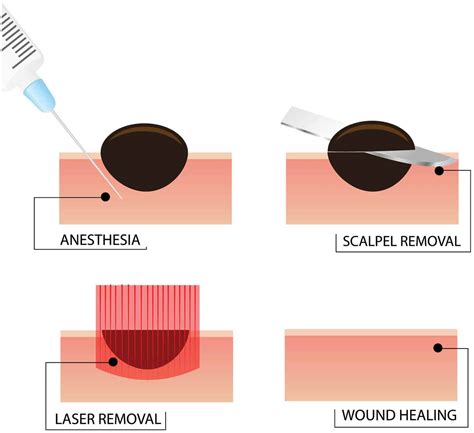 Vancouver Laser Mole Removal & Surgical Removal (in Surrey) | Medical Laser and Skincare Clinic