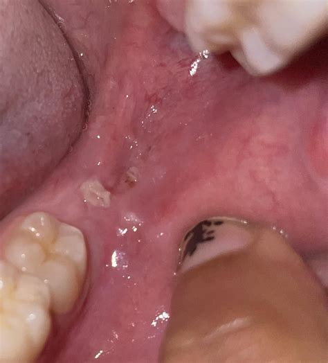 Hole in back of my gums/canker sore?? 2 yrs ago my dentist told me a ...