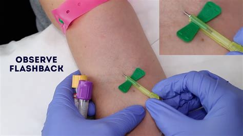 Butterfly Needle Blood Draw