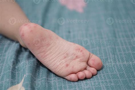 close up view of child's feet infected with hand feet and mouth disease or HFMD originating from ...