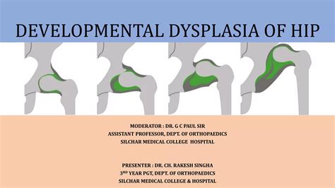 DDH (Developmental Dysplasia of Hip).pptx