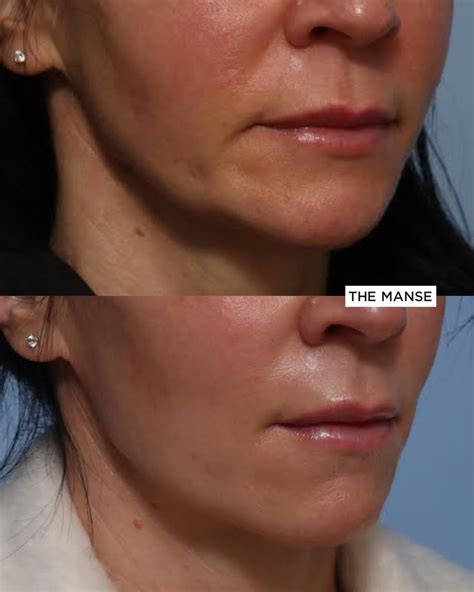 Jowls and Marionette Folds Treatment - Best Cosmetic Clinic Sydney. Advanced practitioners