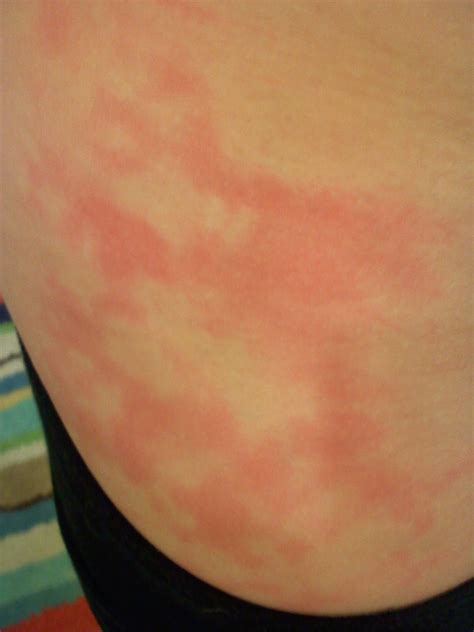 Why Does Heat Rash Spread at David Baltzell blog