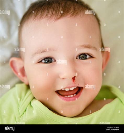 Happy toddler baby boy with a bloody nose. Bleeding from the nose of a ...