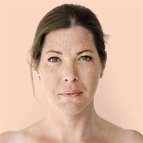 Sun Protection: A Vital Step in Melasma Treatment - Dr Skin