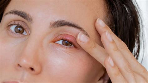 Orbital Cellulitis vs Preseptal Cellulitis: Key Differences