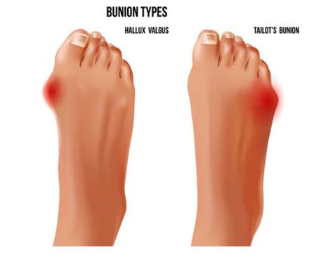 Pinky Toe Turned Sideways: Causes and Some Possible Treatments Explained
